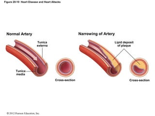 © 2012 Pearson Education, Inc.
Figure 20-10 Heart Disease and Heart Attacks
Narrowing of Artery
Lipid deposit
of plaque
Cross-section
Tunica
externa
Tunica
media
Cross-section
Normal Artery
 