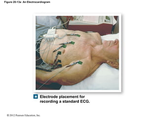 © 2012 Pearson Education, Inc.
Figure 20-13a An Electrocardiogram
Electrode placement for
recording a standard ECG.
 