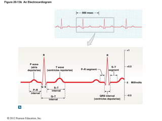 © 2012 Pearson Education, Inc.
Figure 20-13b An Electrocardiogram
800 msec
SQ
QRS interval
(ventricles depolarize)
Millivolts
R
P–R segment
T wave
(ventricles repolarize)
R
P wave
(atria
depolarize)
S–T
segment
S–T
interval
Q–T
interval
P–R
interval
 