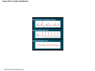 © 2012 Pearson Education, Inc.
Figure 20-14 Cardiac Arrhythmias
Premature Ventricular Contractions (PVCs)
Ventricular Tachycardia (VT)
Ventricular Fibrillation (VF)
PPP
P
TTT
 