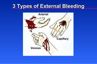 Bleeding and Shock | PPT
