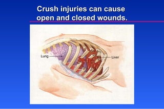 Crush injuries can cause  open and closed wounds. 