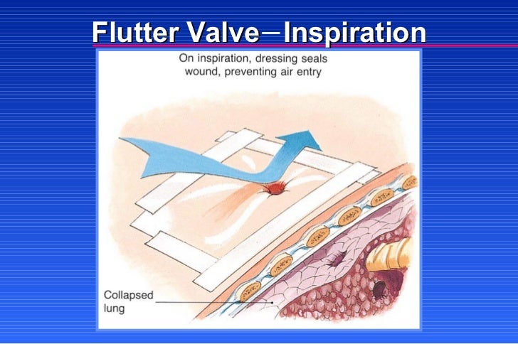flutter valve for pneumonia secretions