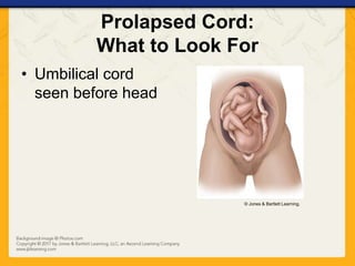 Prolapsed Cord:
What to Look For
• Umbilical cord
seen before head
© Jones & Bartlett Learning.
 