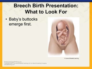 Breech Birth Presentation:
What to Look For
• Baby’s buttocks
emerge first.
© Jones & Bartlett Learning.
 