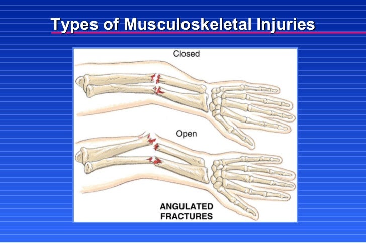 multiple musculoskeletal trauma