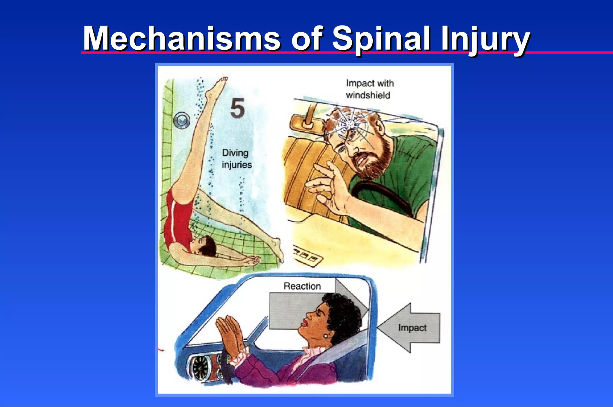 Mechanisms of Spinal Injury 