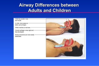 Airway Differences between  Adults and Children 