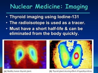 Nuclear Medicine: Imaging Thyroid imaging using Iodine-131 The radioisotope is used as a tracer. Must have a short half-life & can be eliminated from the body quickly. 
