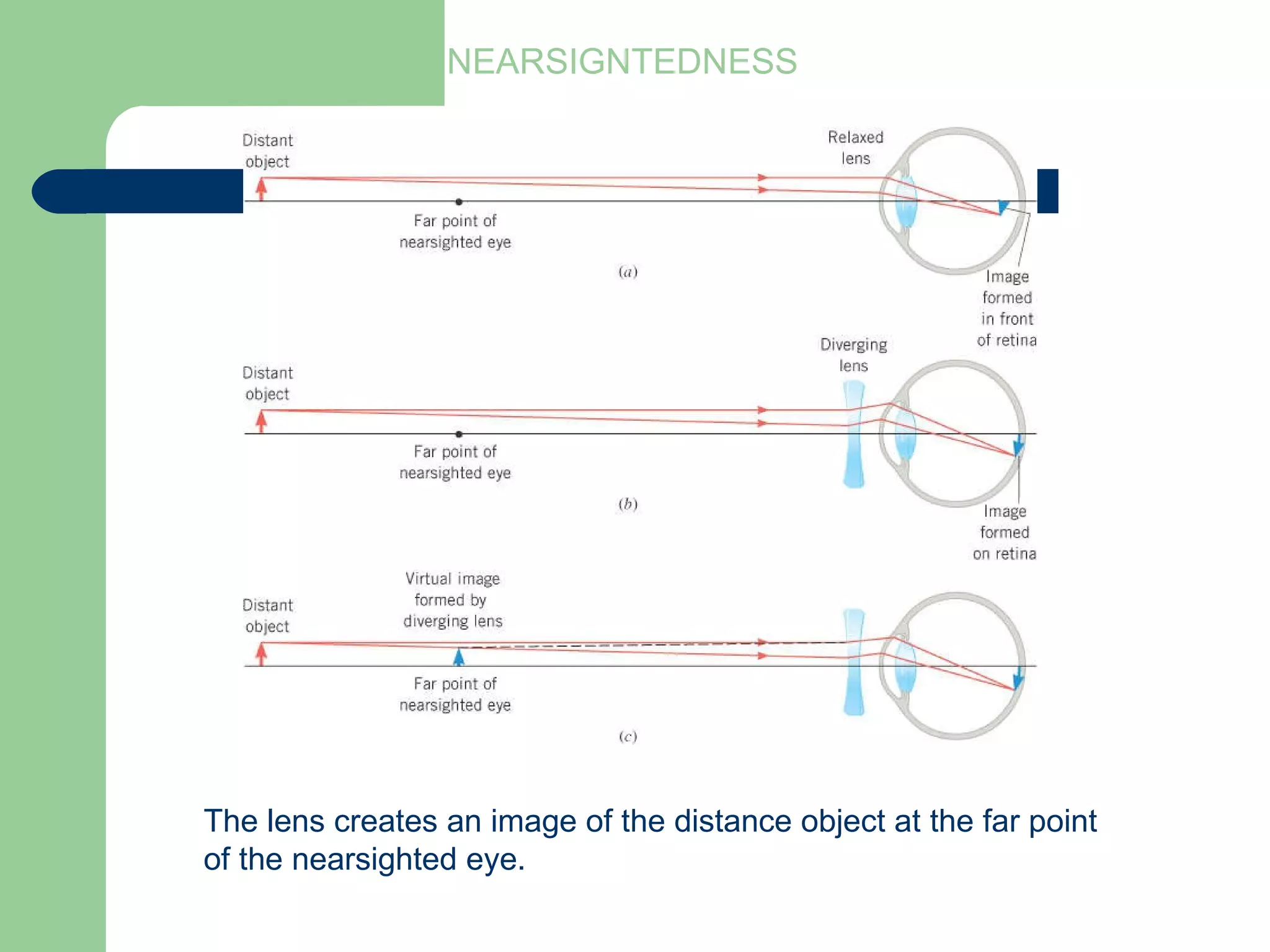 NEARSIGNTEDNESS The lens creates an image of the distance object at the far point of the nearsighted eye. 
