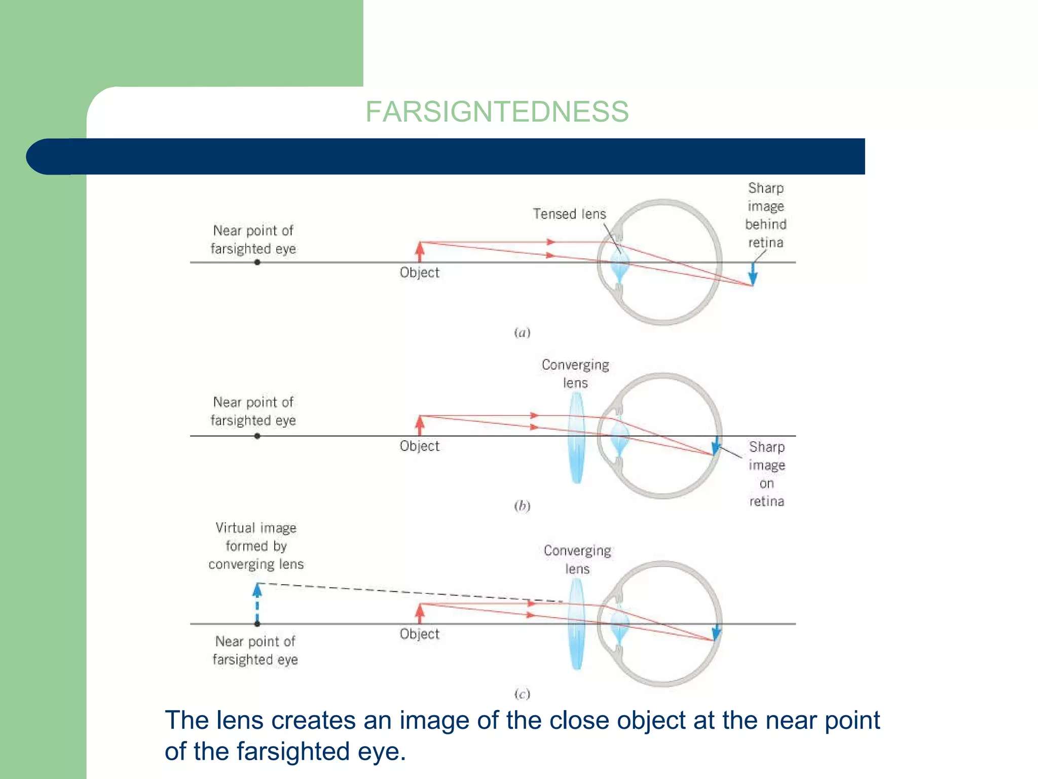 FARSIGNTEDNESS The lens creates an image of the close object at the near point of the farsighted eye.  