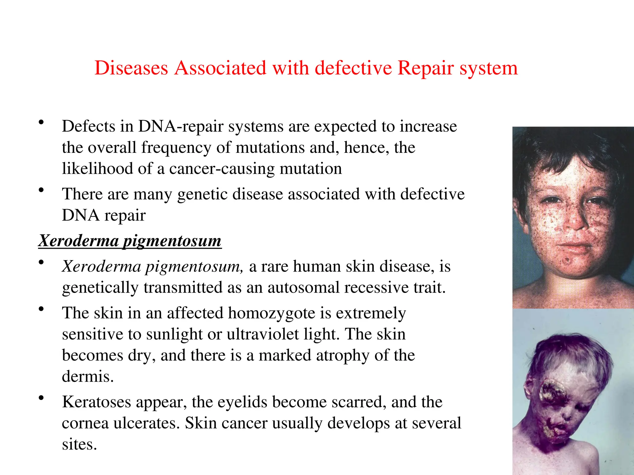 Diseases Associated with defective Repair system
• Defects in DNA-repair systems are expected to increase
the overall frequency of mutations and, hence, the
likelihood of a cancer-causing mutation
• There are many genetic disease associated with defective
DNA repair
Xeroderma pigmentosum
• Xeroderma pigmentosum, a rare human skin disease, is
genetically transmitted as an autosomal recessive trait.
• The skin in an affected homozygote is extremely
sensitive to sunlight or ultraviolet light. The skin
becomes dry, and there is a marked atrophy of the
dermis.
• Keratoses appear, the eyelids become scarred, and the
cornea ulcerates. Skin cancer usually develops at several
sites.
 