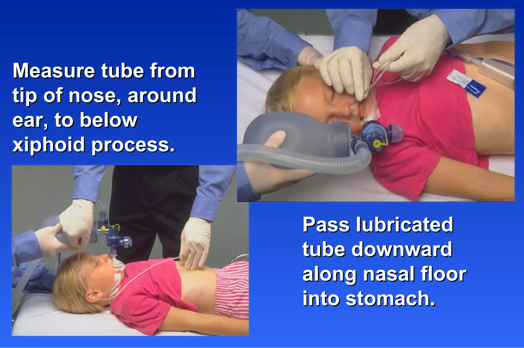 Measure tube from tip of nose, around  ear, to below  xiphoid process. Pass lubricated tube downward along nasal floor into stomach. 