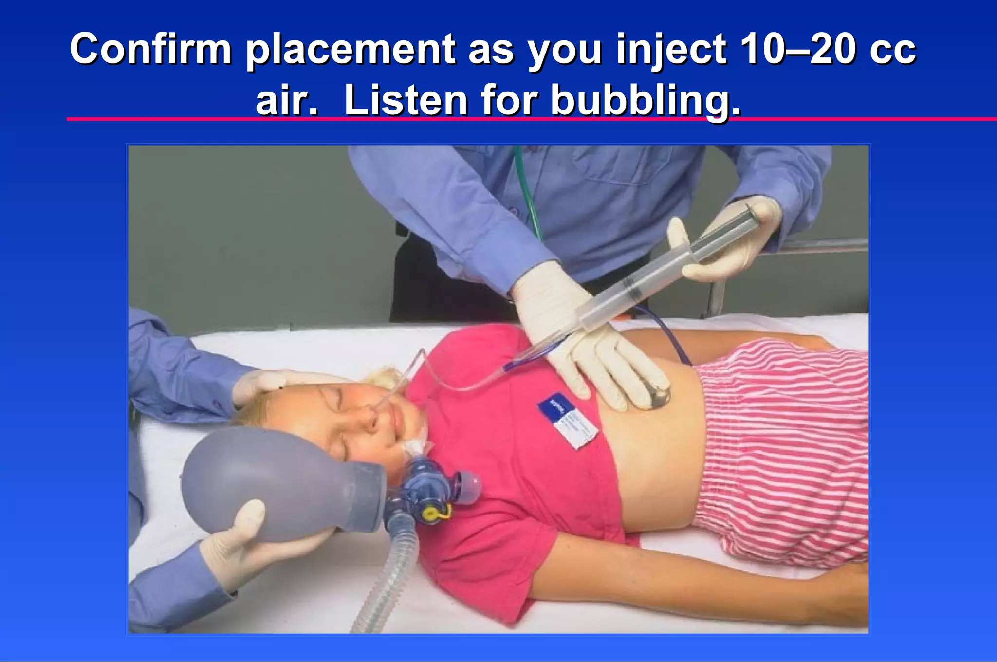 Confirm placement as you inject 10–20 cc  air.  Listen for bubbling. 