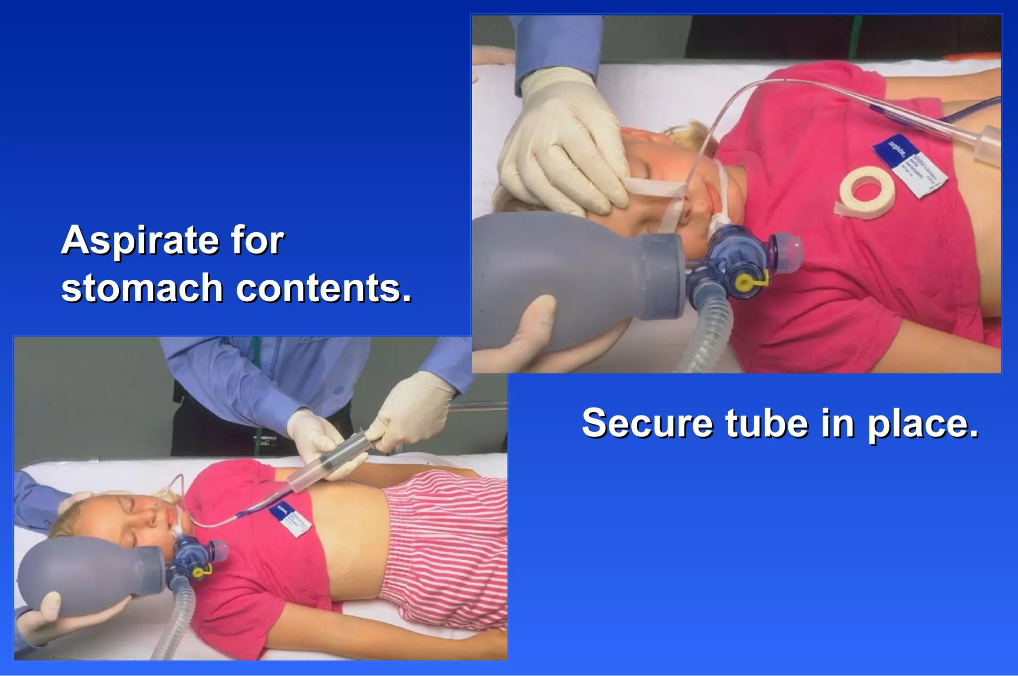 Aspirate for  stomach contents. Secure tube in place. 