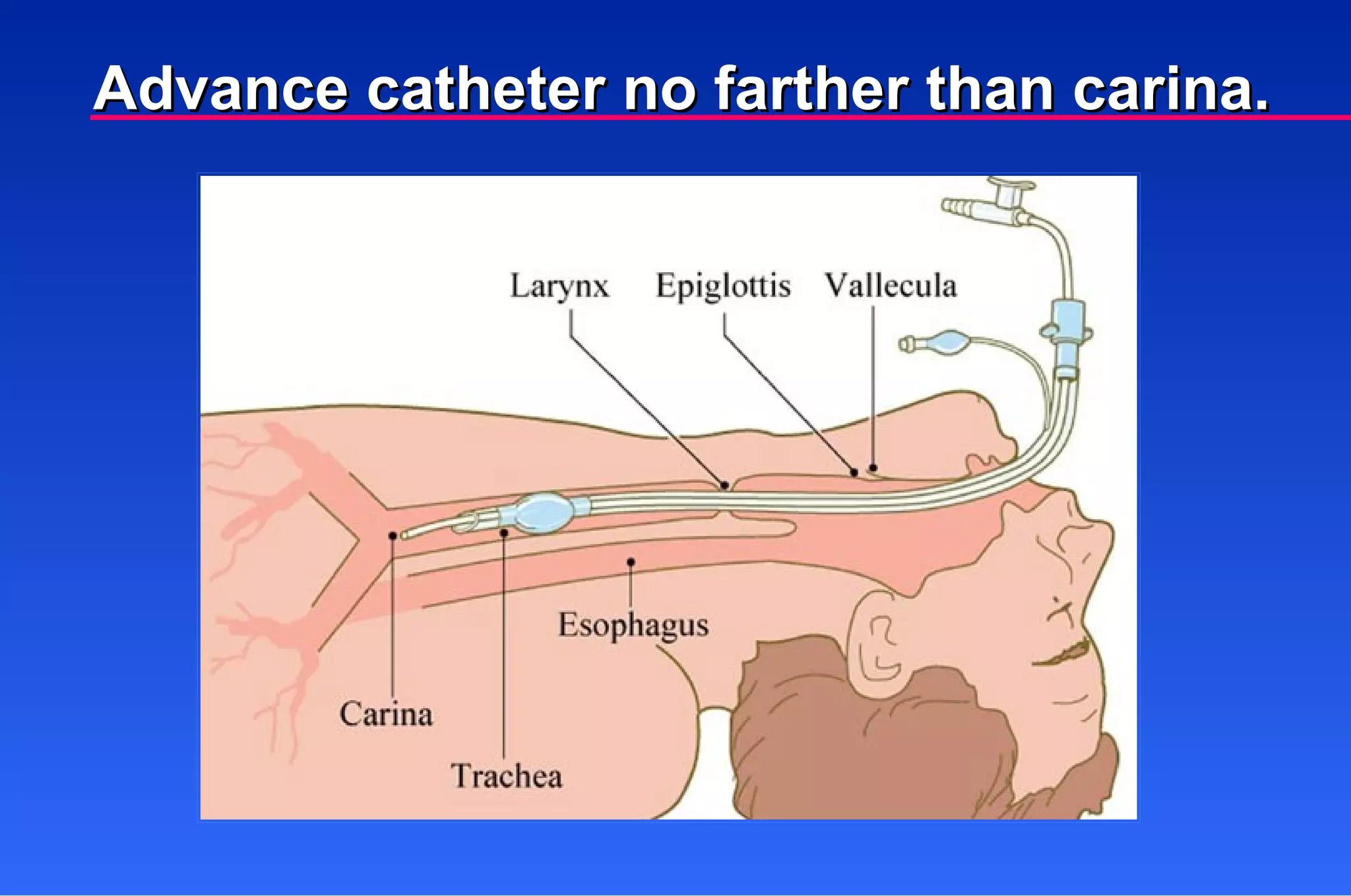 Advance catheter no farther than carina. 