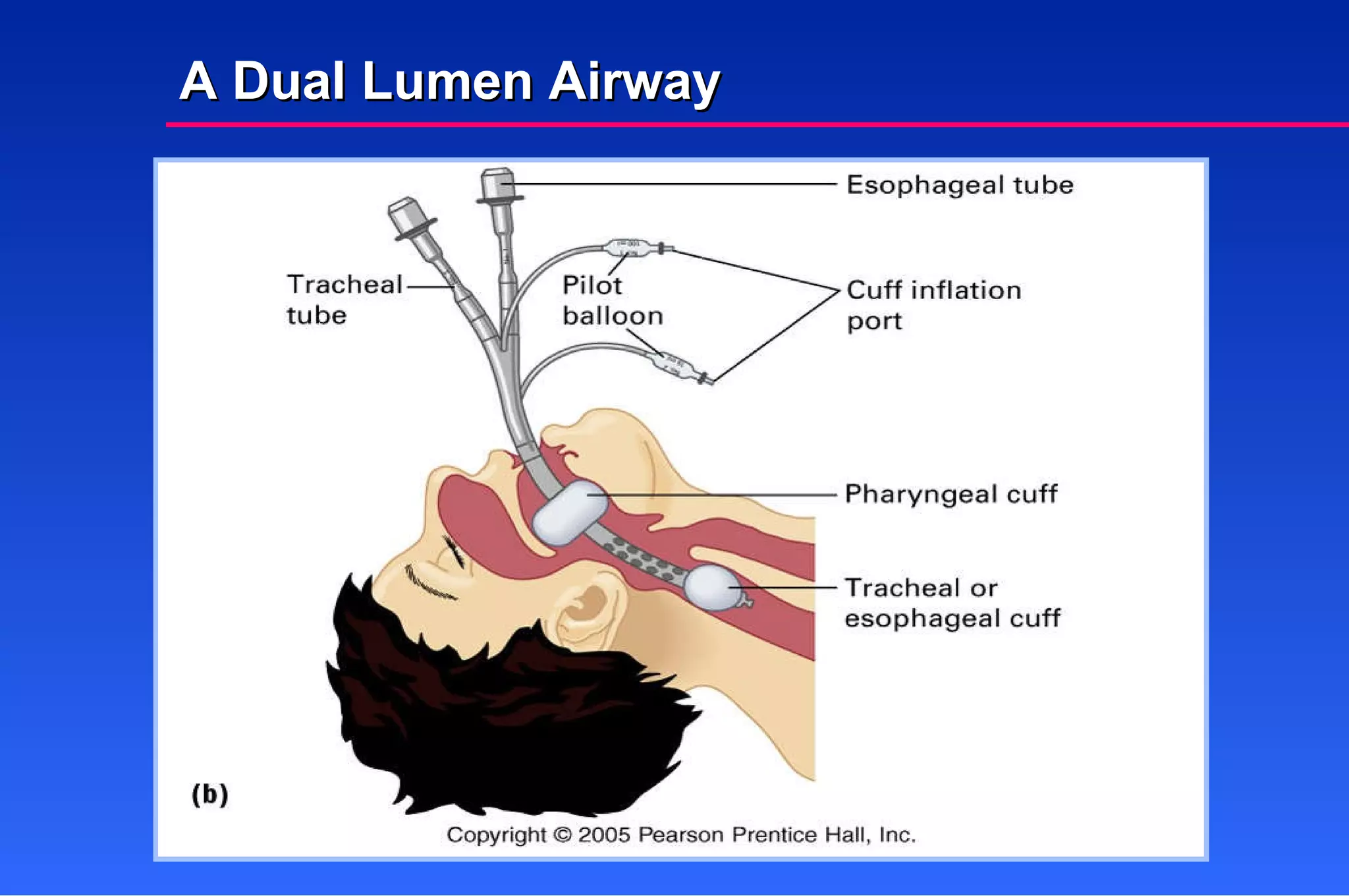 A Dual Lumen Airway 