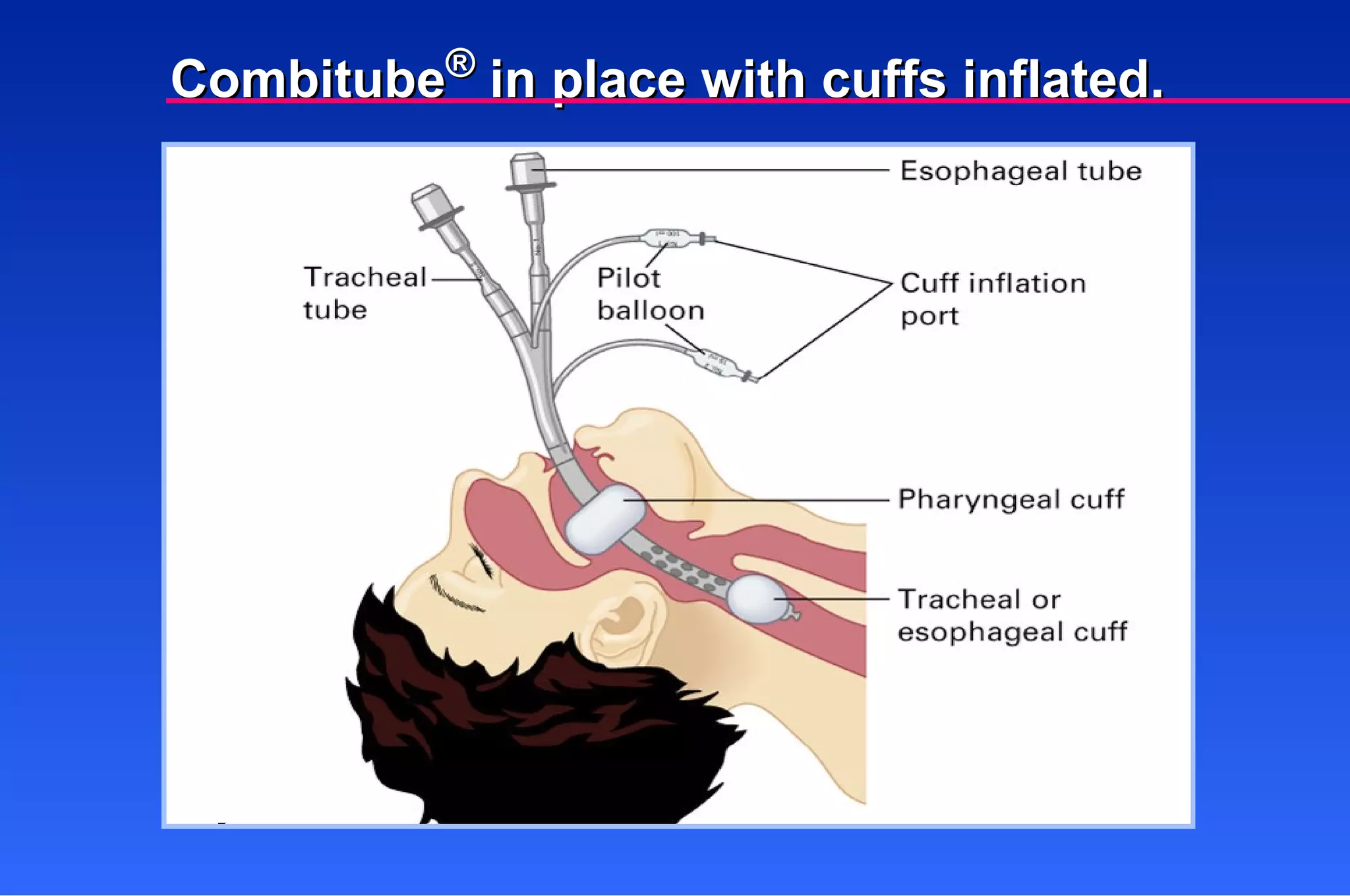 Combitube ®  in place with cuffs inflated. 