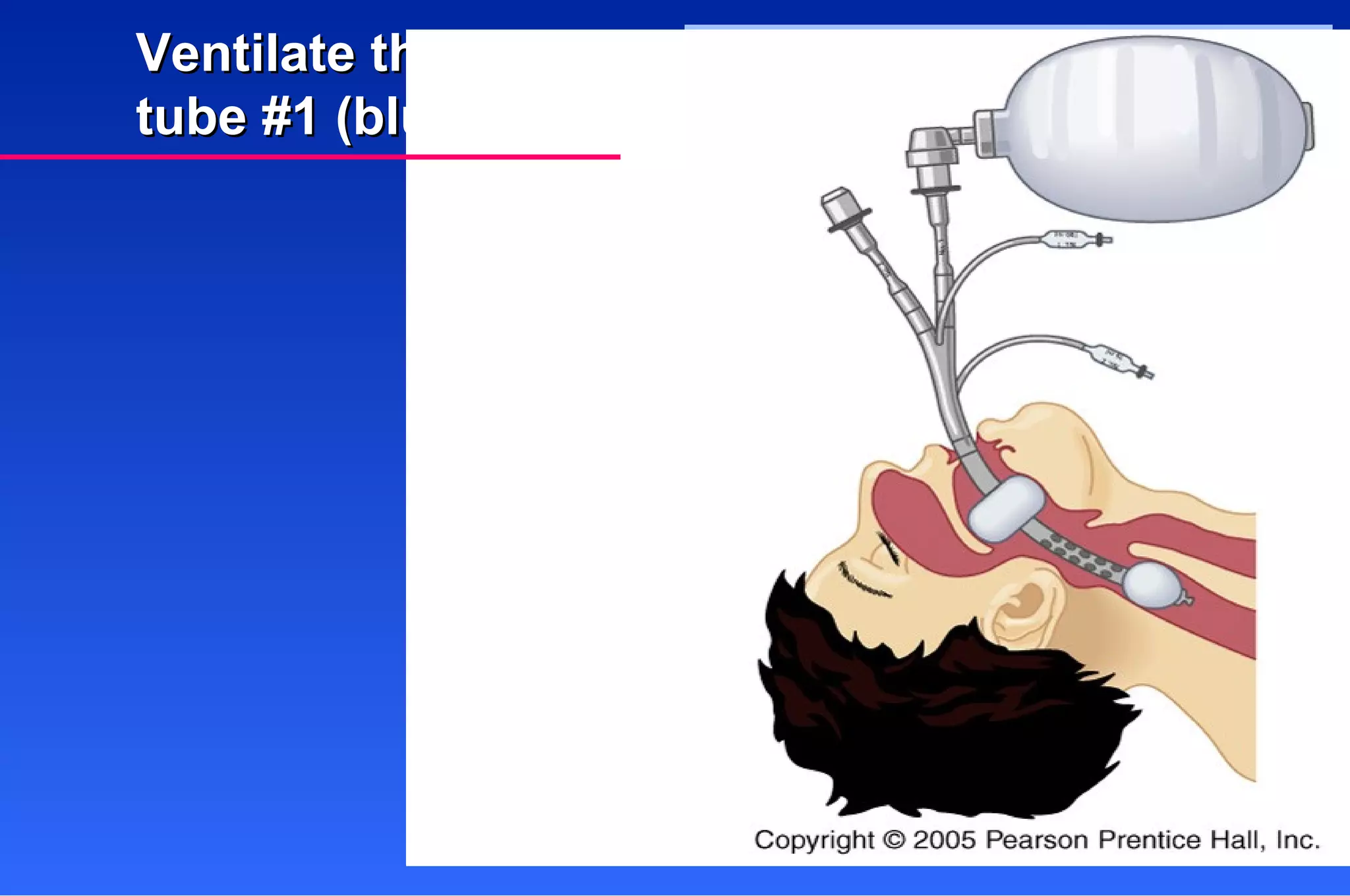Ventilate through tube #1 (blue tube). 