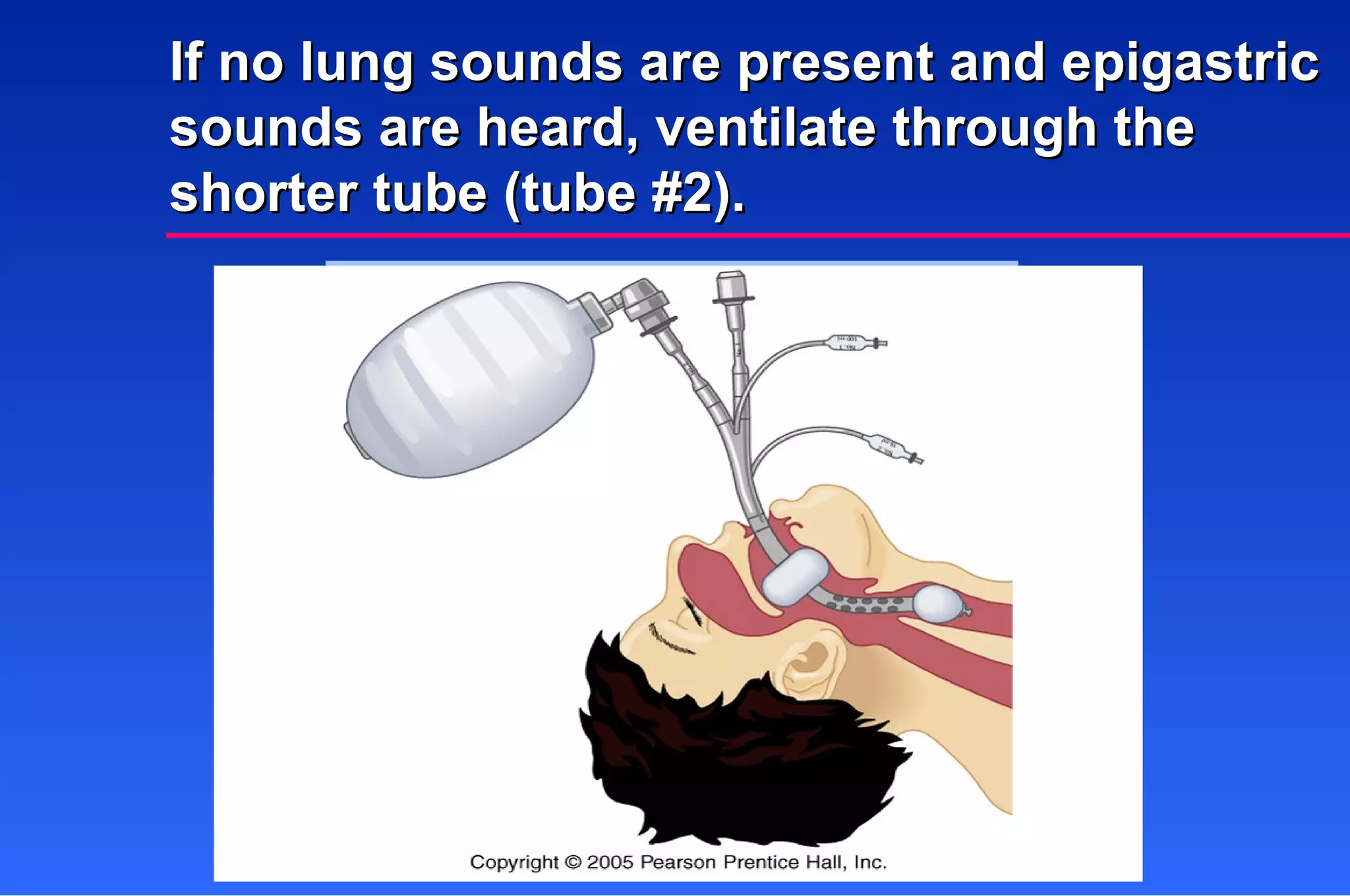 If no lung sounds are present and epigastric sounds are heard, ventilate through the shorter tube (tube #2). 