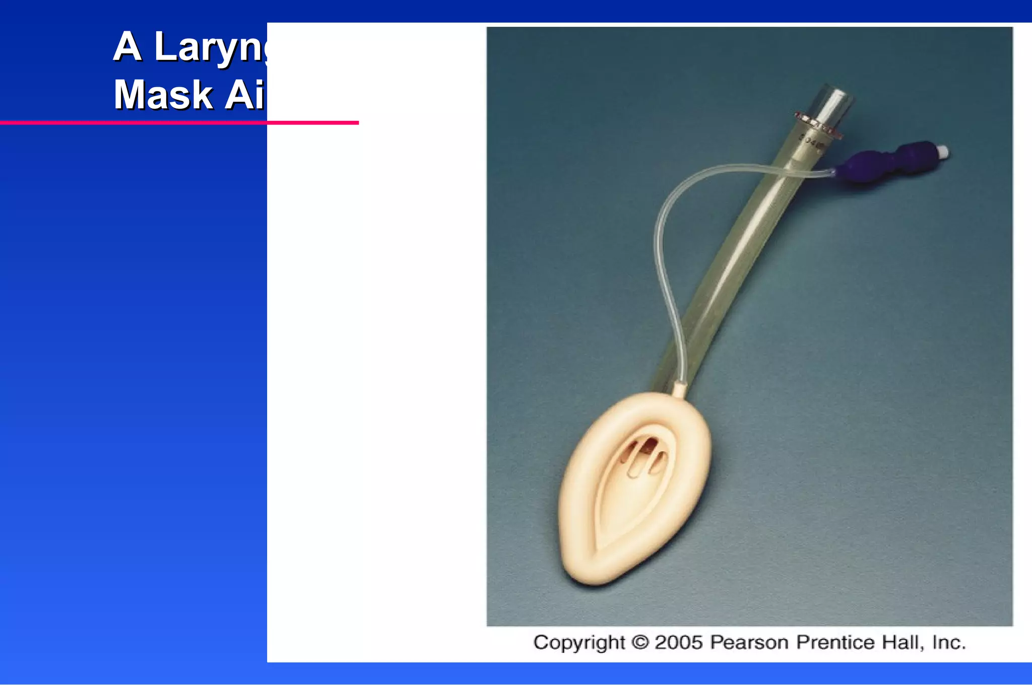 A Laryngeal  Mask Airway 