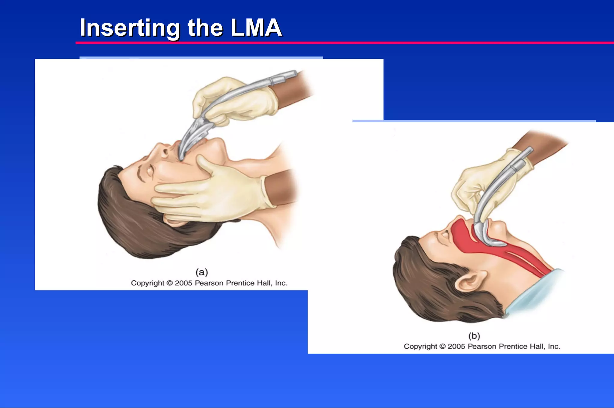 Inserting the LMA 