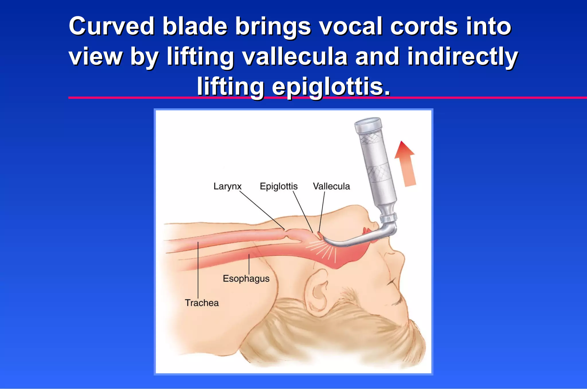 Curved blade brings vocal cords into  view by lifting vallecula and indirectly lifting epiglottis. 