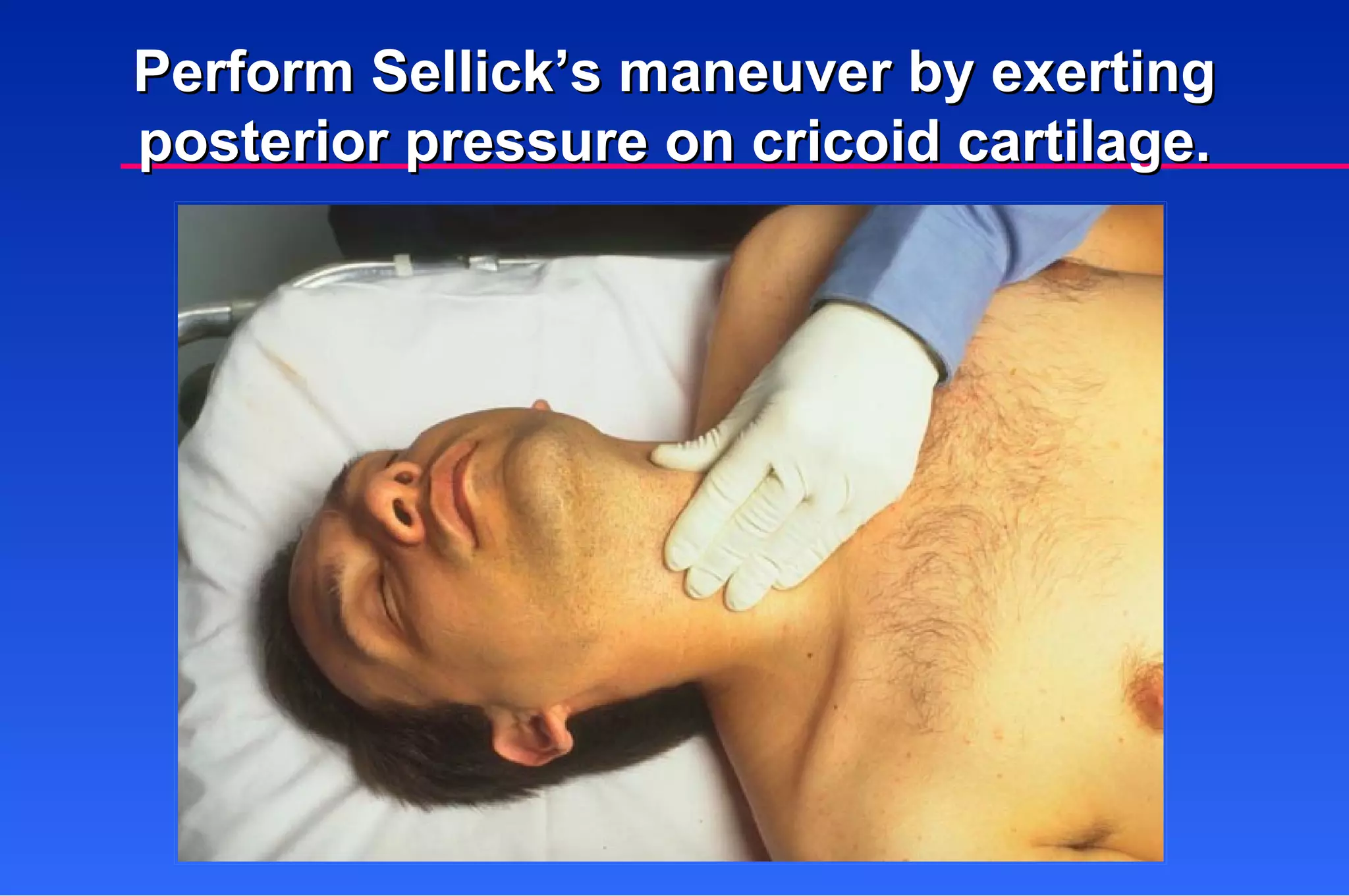 Perform Sellick’s maneuver by exerting posterior pressure on cricoid cartilage. 