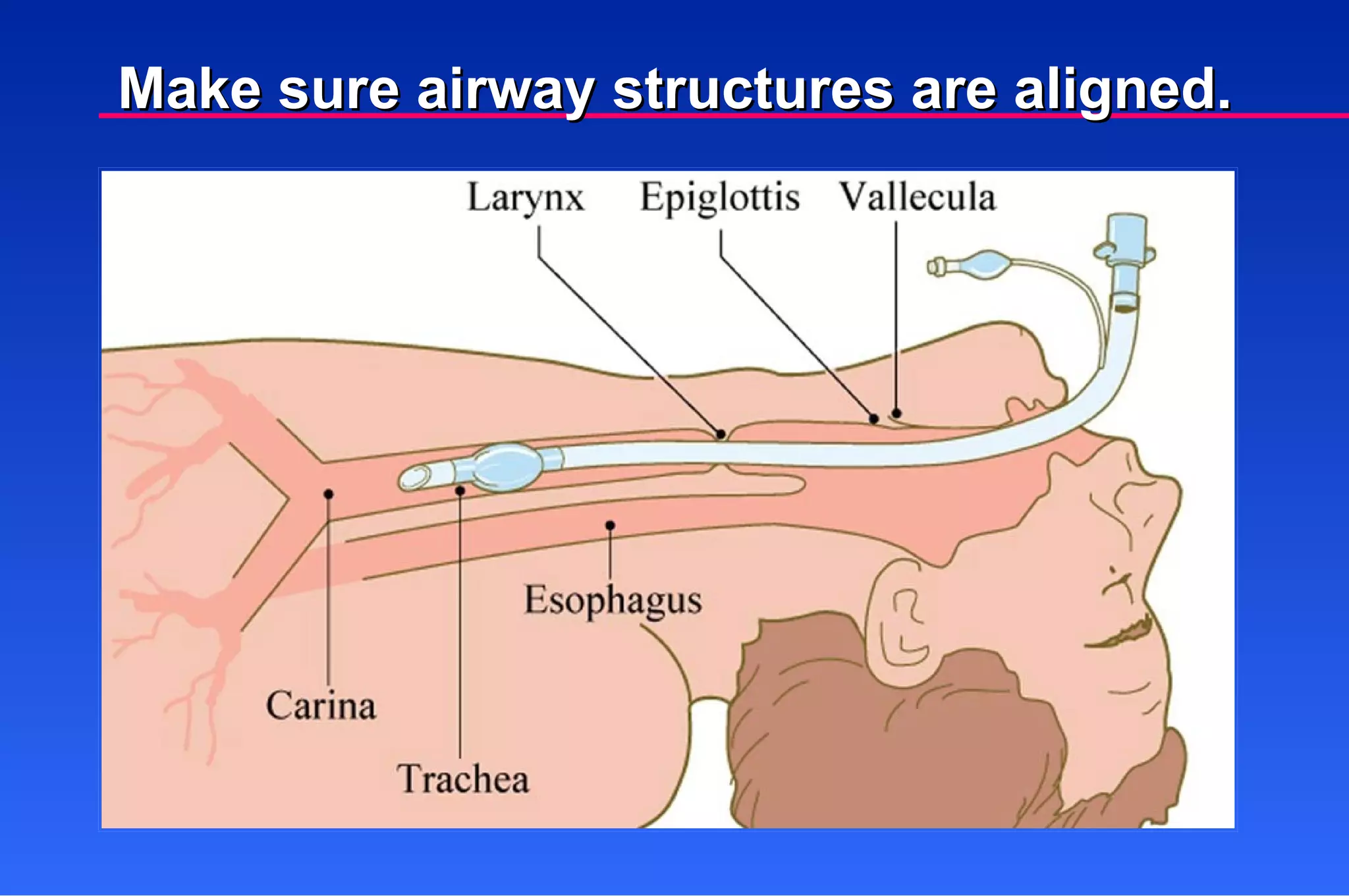 Make sure airway structures are aligned. 