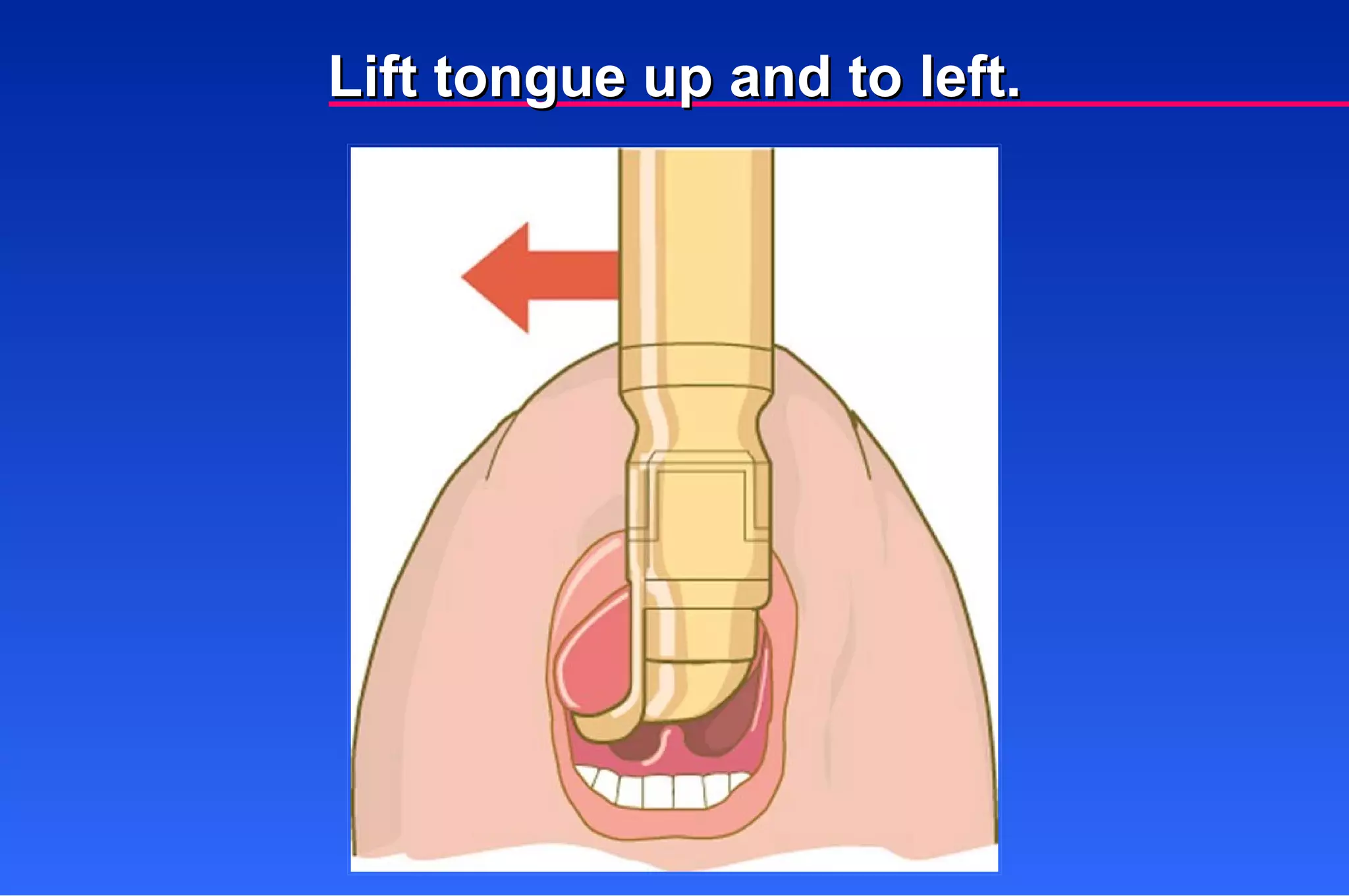 Lift tongue up and to left. 