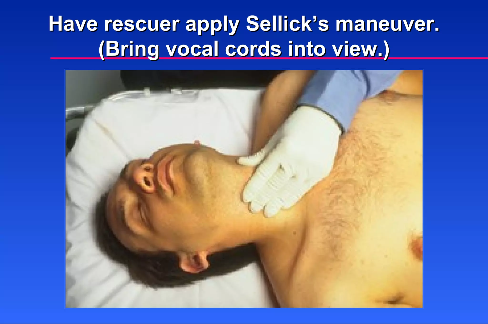 Have rescuer apply Sellick’s maneuver. (Bring vocal cords into view.) 