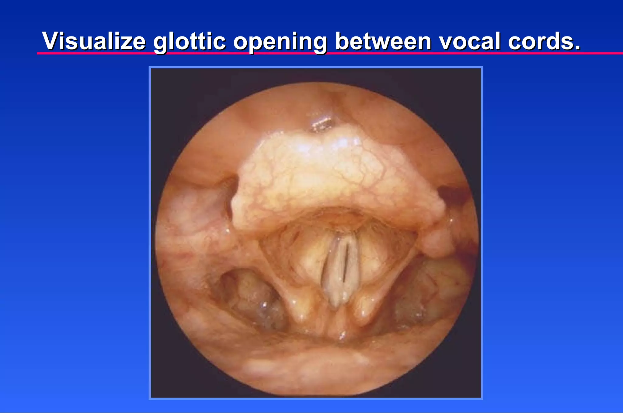 Visualize glottic opening between vocal cords. 