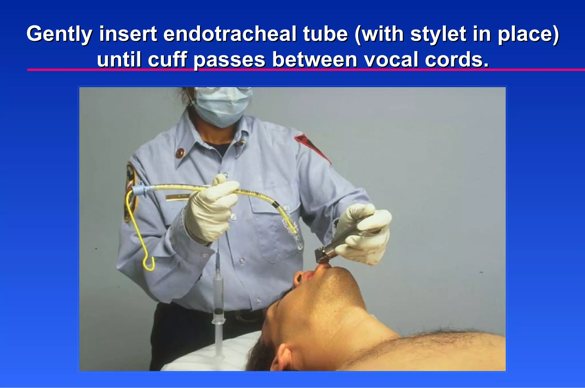 Gently insert endotracheal tube (with stylet in place) until cuff passes between vocal cords. 