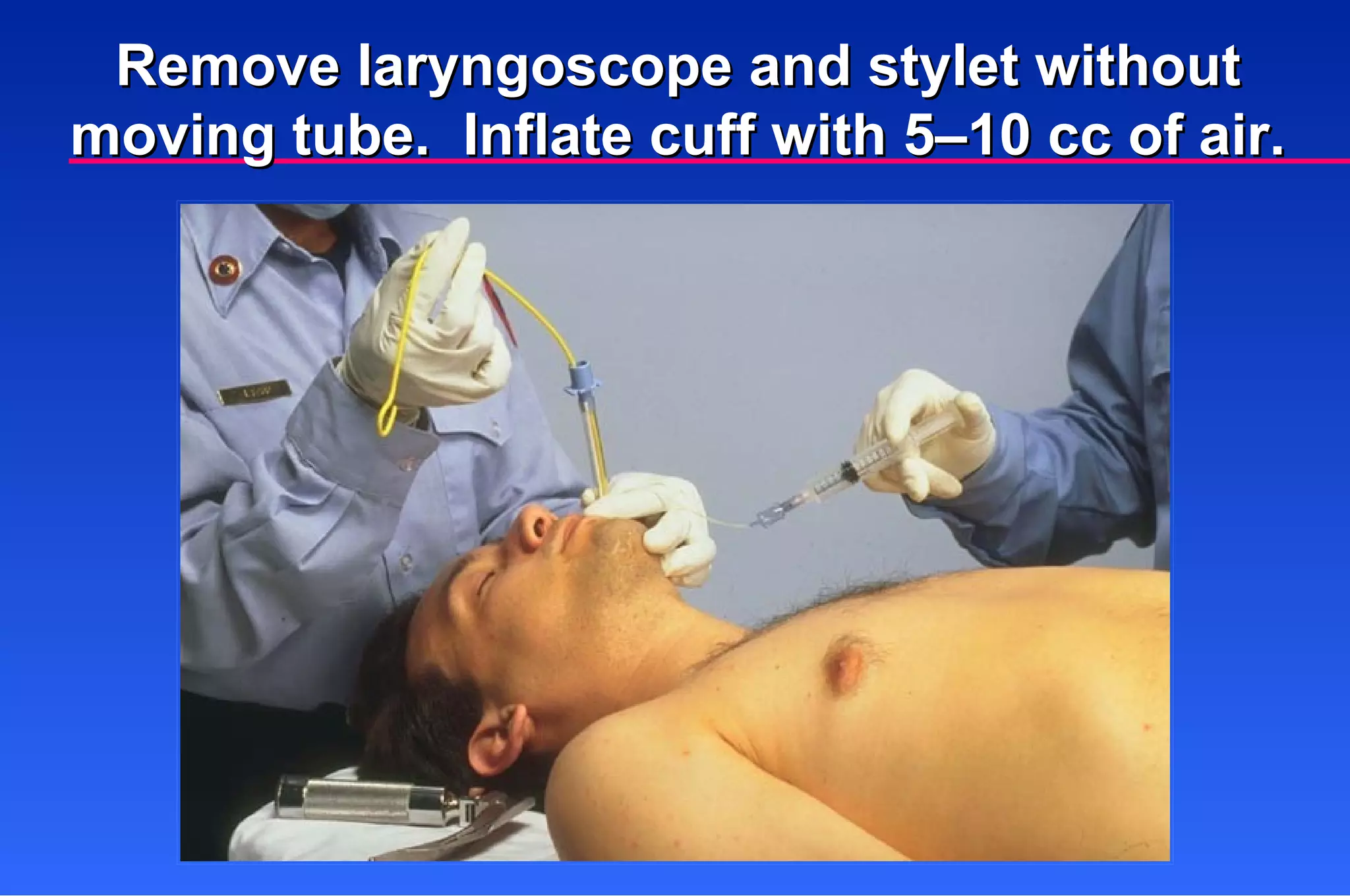 Remove laryngoscope and stylet without moving tube.  Inflate cuff with 5–10 cc of air. 