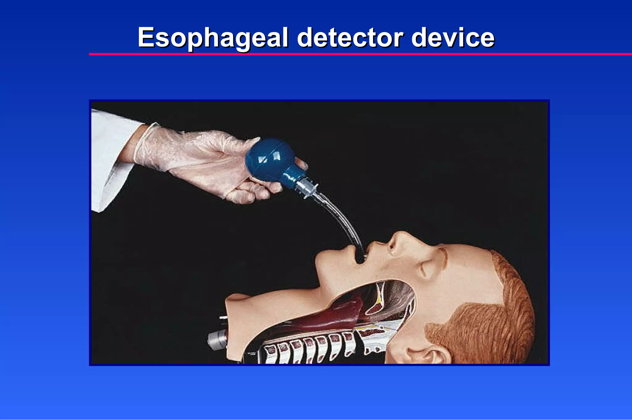 Esophageal detector device 