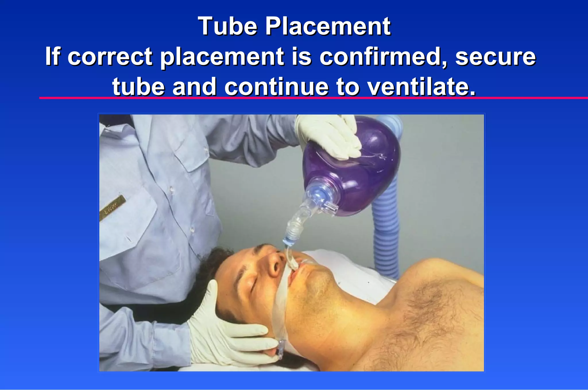 Tube Placement If correct placement is confirmed, secure  tube and continue to ventilate. 