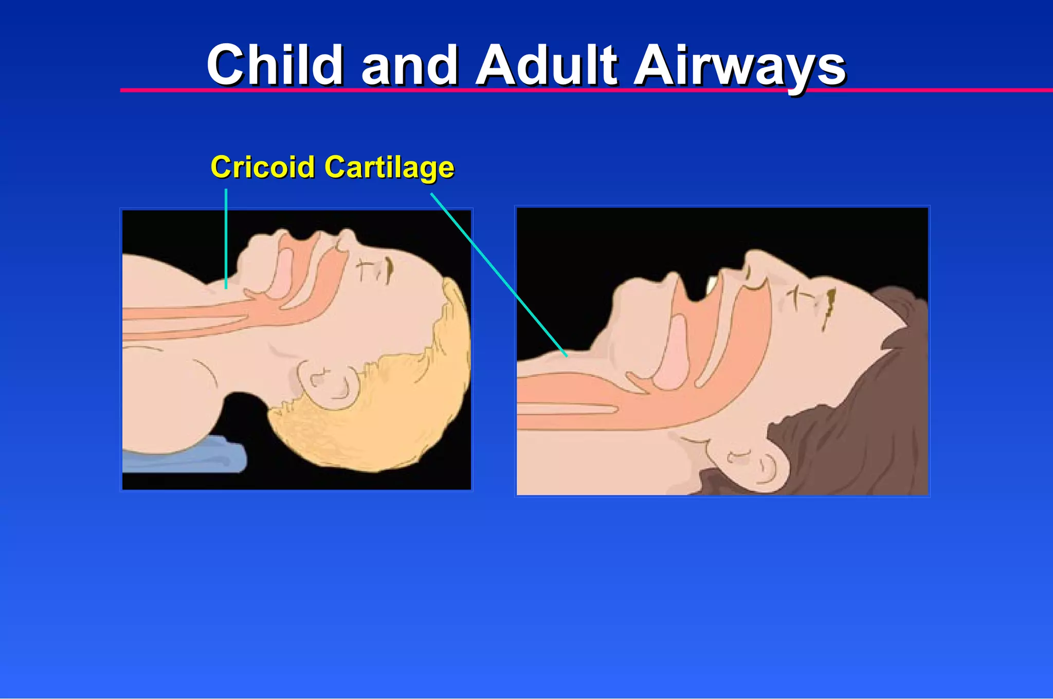 Cricoid Cartilage Child and Adult Airways 
