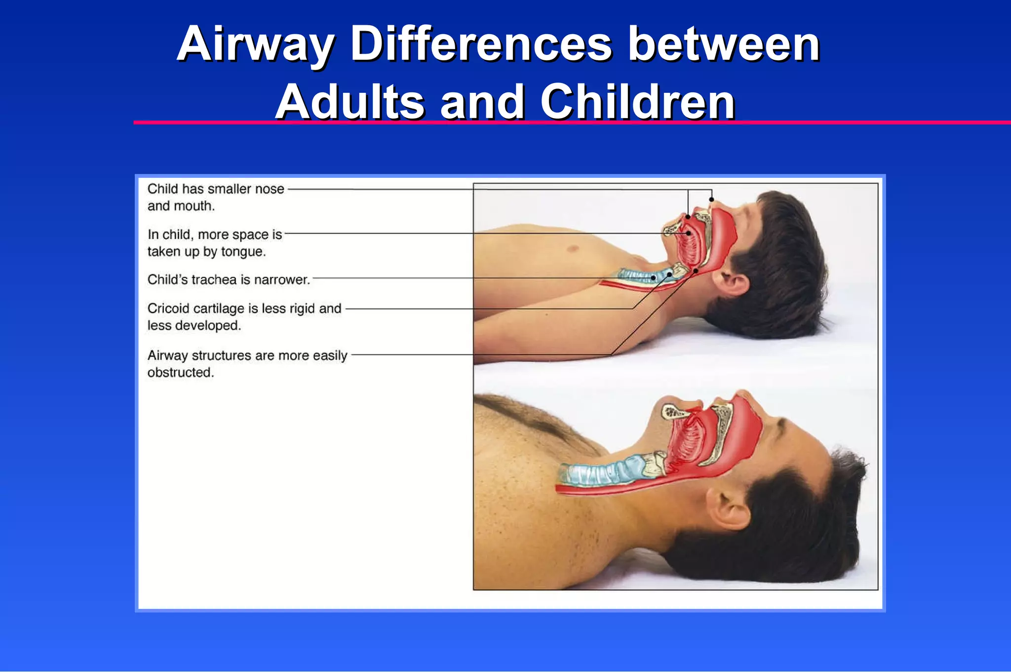 Airway Differences between  Adults and Children 