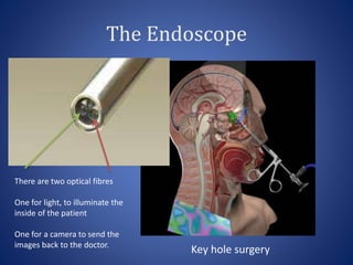 The Endoscope
There are two optical fibres
One for light, to illuminate the
inside of the patient
One for a camera to send the
images back to the doctor.
Key hole surgery
 