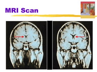 MRI Scan
 