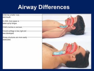 Airway Differences
 