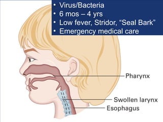 • Virus/Bacteria
• 6 mos – 4 yrs
• Low fever, Stridor, “Seal Bark”
• Emergency medical care
 