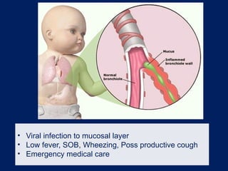 • Viral infection to mucosal layer
• Low fever, SOB, Wheezing, Poss productive cough
• Emergency medical care
 