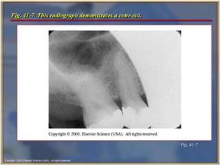 Undercut Radiograph ch41.ppt