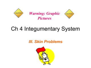 Warning: Graphic
          Pictures

Ch 4 Integumentary System

      III. Skin Problems
 