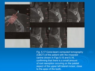 Fig. 5.17 Cone-beam computed tomography
(CBCT) of the patient with the impacted
canine shown in Figs 5.15 and 5.16,
confirming that there is a small amount
of root resorption occuring on the palatal
aspect of the upper left lateral incisor, close
to the apex of the tooth.
 
