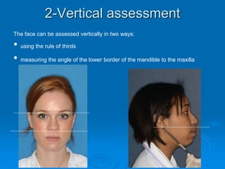 2-Vertical assessment
The face can be assessed vertically in two ways:
• using the rule of thirds
• measuring the angle of the lower border of the mandible to the maxilla
 