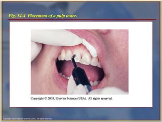 Fig. 54-4  Placement of a pulp tester. 