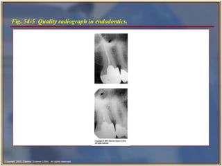 Fig. 54-5  Quality radiograph in endodontics.  