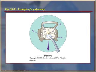 Fig. 54-13  Example of a pulpotomy. 